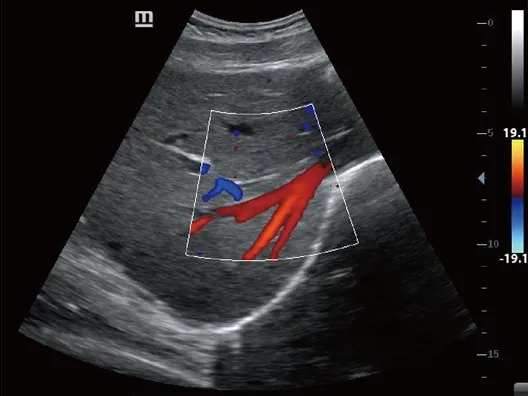 Клинические изображения УЗИ аппарат Mindray Z60 портативный
