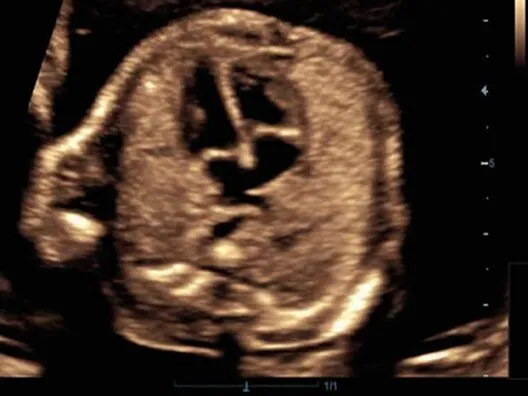 Клинические изображения УЗИ аппарат Mindray DC-70 Exp