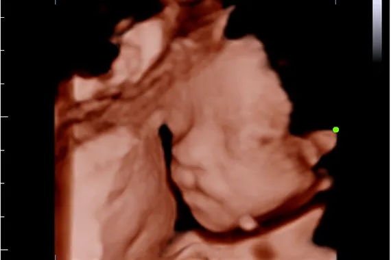 Клинические изображения УЗИ аппарат Mindray DC-45