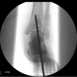 Клинические изображения Philips BV Endura С-дуга