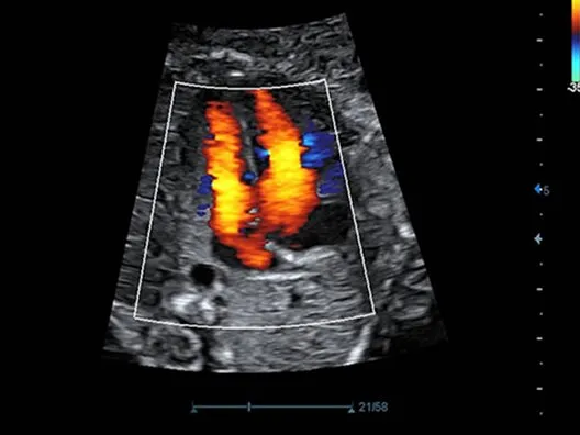 Клинические изображения УЗИ аппарат Mindray DC-70 Exp