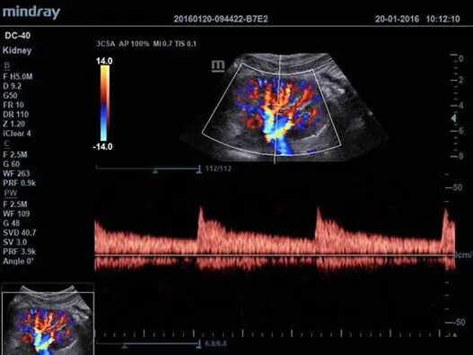 Клинические изображения УЗИ аппарат Mindray DC-40 Exp