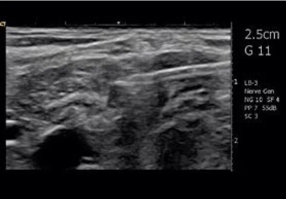 Клинические изображения Siemens Acuson Freestyle УЗИ аппарат портативный