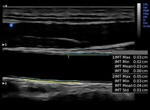 Клинические изображения УЗИ аппарат Chison SonoTouch 80 портативный