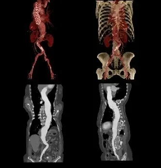 Клинические изображения Canon Aquilion ONE PRISM Edition компьютерный томограф