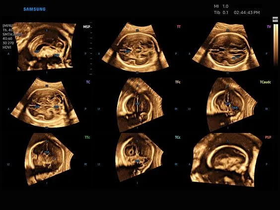 Клинические изображения Samsung Medison W9 УЗИ аппарат