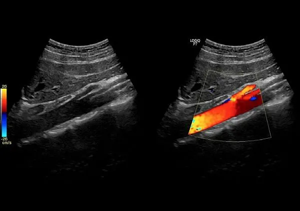 Клинические изображения Logiq P7 УЗИ аппарат GE
