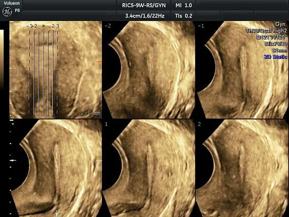 Клинические изображения УЗИ аппарат GE HealthCare Voluson P8