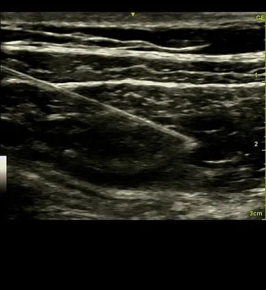 Клинические изображения GE Venue 50 аппарат УЗИ портативный