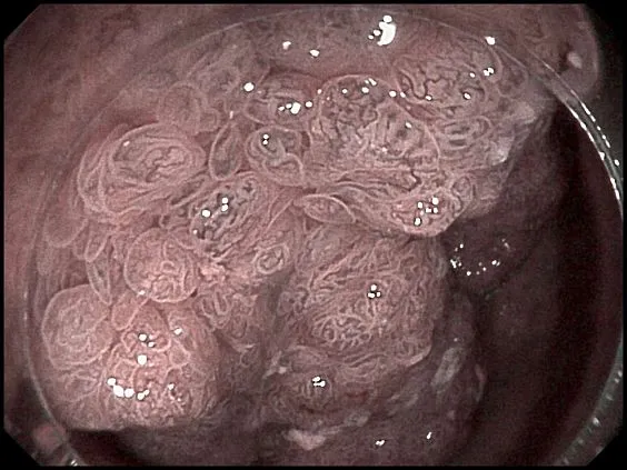 Клинические изображения SonoScape HD-500 видеоэндоскопическая система