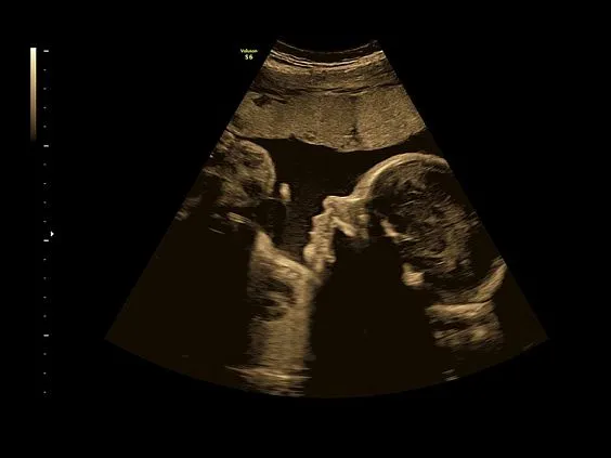 Клинические изображения GE Voluson S6 аппарат УЗИ