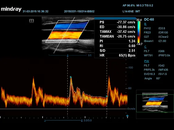 Клинические изображения УЗИ аппарат Mindray DC-60 X-Insight