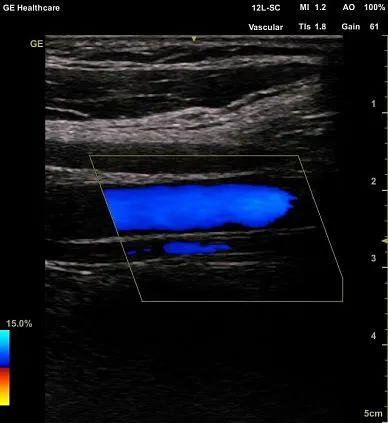 Клинические изображения GE Venue 50 аппарат УЗИ портативный