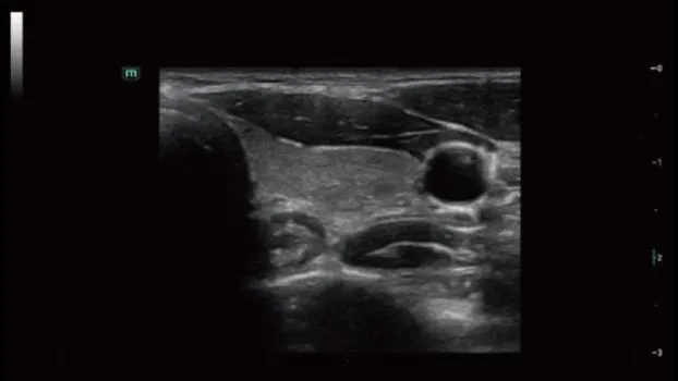 Клинические изображения УЗИ аппарат Mindray Consona N7