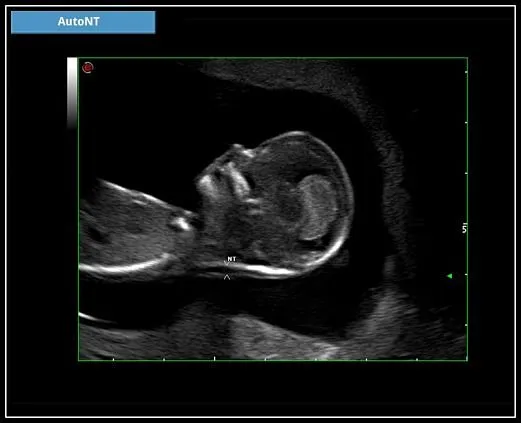 Клинические изображения УЗИ аппарат Esaote MyLab X7
