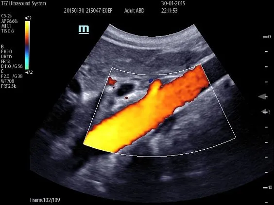 Клинические изображения УЗИ аппарат Mindray TE7 портативный