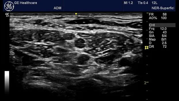 Клинические изображения Портативная ультразвуковая система GE HealthCare Logiq e