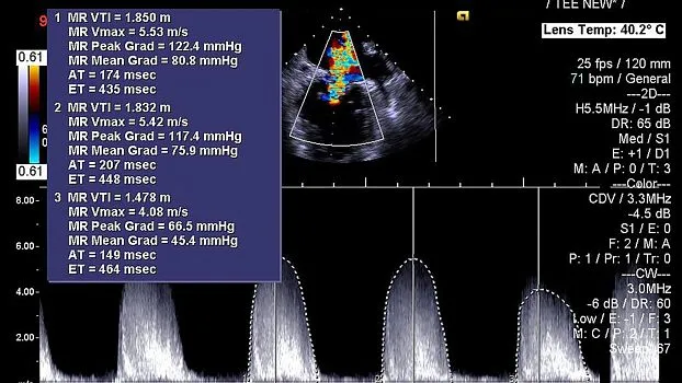 Клинические изображения Siemens Acuson SC2000 ультразвуковая система