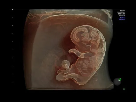 Клинические изображения Ультразвуковая диагностическая система GE Voluson E10