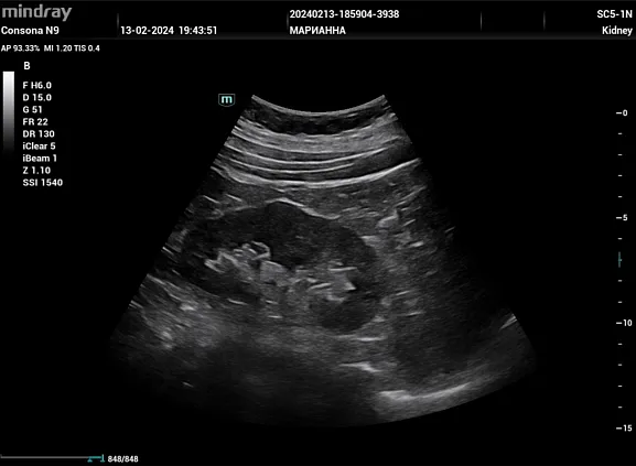 Клинические изображения УЗИ аппарат Mindray Consona N9