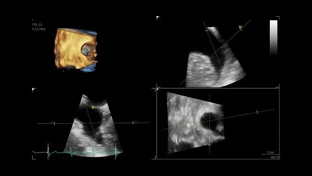 Клинические изображения Ультразвуковая диагностическая система GE HealthCare Vivid iQ портативная
