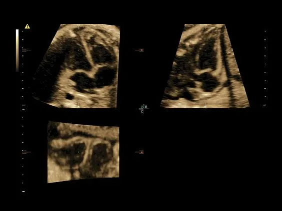 Клинические изображения Ультразвуковая диагностическая система GE Voluson E10