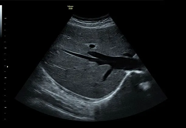 Клинические изображения УЗИ аппарат GE HealthCare Voluson S10