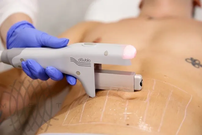 Аппарат ультразвукового SMAS-лифтинга Hironic Doublo