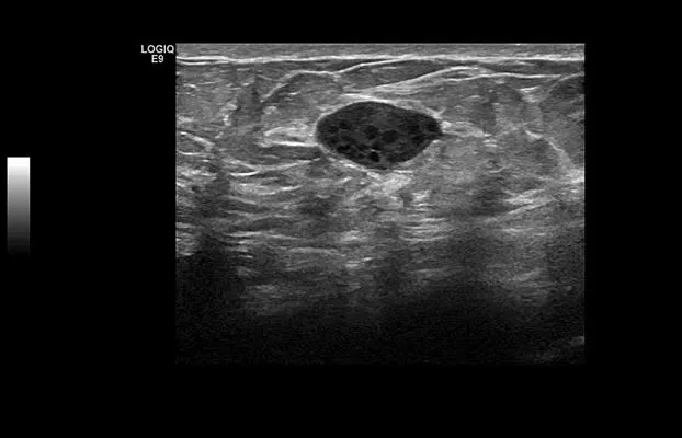 Клинические изображения УЗИ аппарат GE Healthcare Logiq E9 XDclear