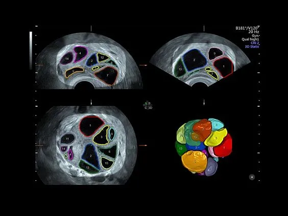 Клинические изображения GE Voluson S8 ультразвуковой аппарат