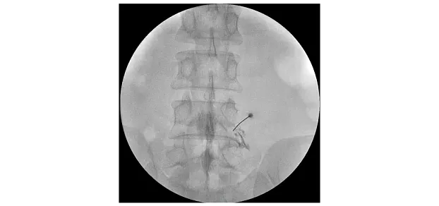 Клинические изображения Philips BV Vectra С-дуга