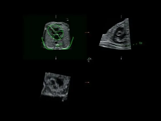 Клинические изображения УЗИ аппарат GE HealthCare Voluson E8 