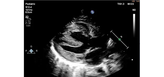 Клинические изображения Philips EPIQ CVx ультразвуковой аппарат