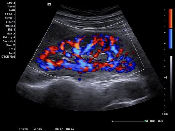 Клинические изображения Siemens Acuson NX2 аппарат УЗИ