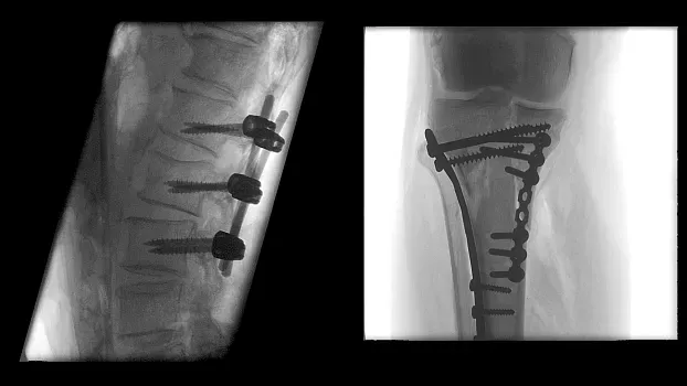 Клинические изображения Мобильный рентгенохирургический аппарат типа C-дуга Siemens Cios Flow