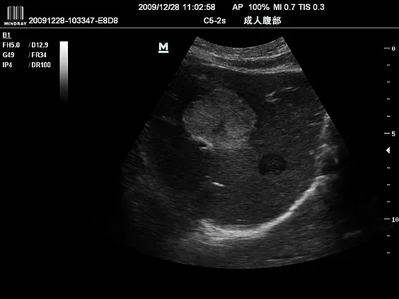 Клинические изображения УЗИ аппарат Mindray DC-N6