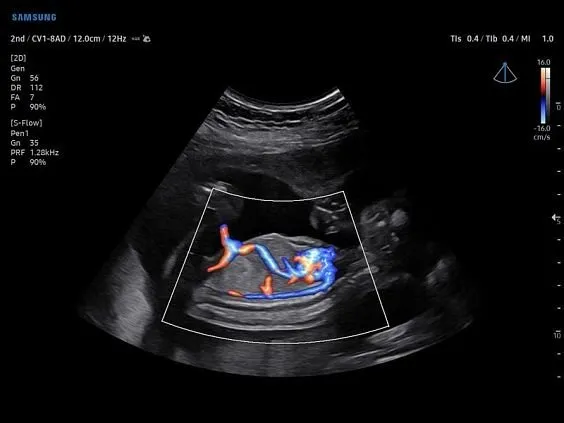 Клинические изображения Samsung Medison V7 УЗИ аппарат