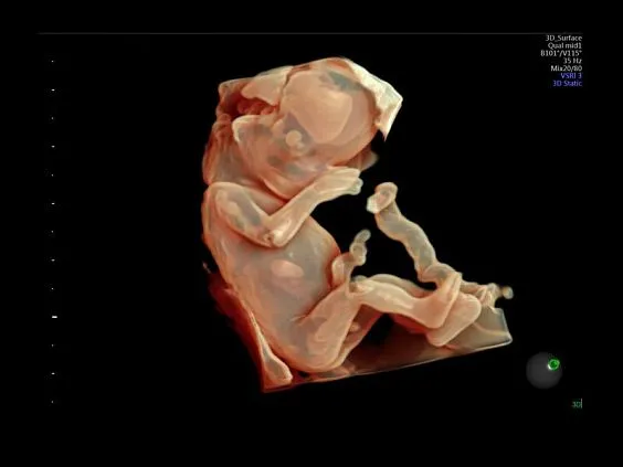 Клинические изображения Ультразвуковая диагностическая система GE Voluson E10