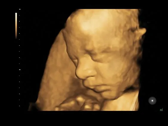 Клинические изображения GE Voluson S6 аппарат УЗИ