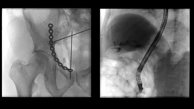 Клинические изображения Мобильный рентгенохирургический аппарат типа C-дуга Siemens Cios Flow