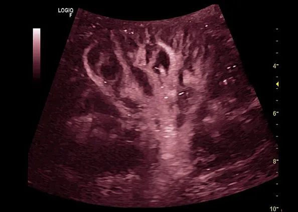 Клинические изображения GE Logiq F8 аппарат УЗИ