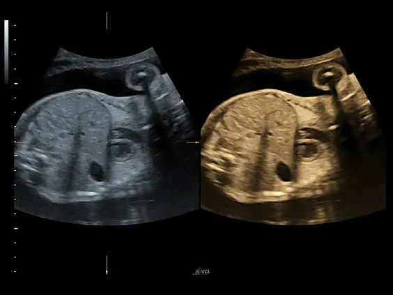 Клинические изображения GE Voluson S8 ультразвуковой аппарат