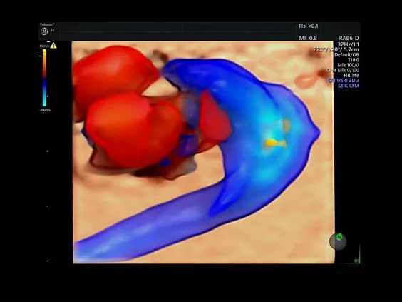 Клинические изображения УЗИ аппарат GE HealthCare Voluson E8 
