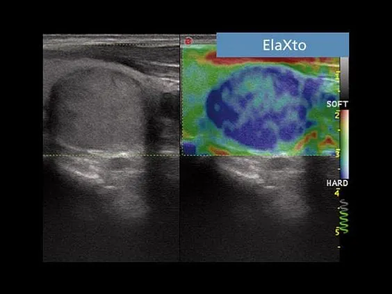 Клинические изображения УЗИ аппарат Esaote MyLab Seven
