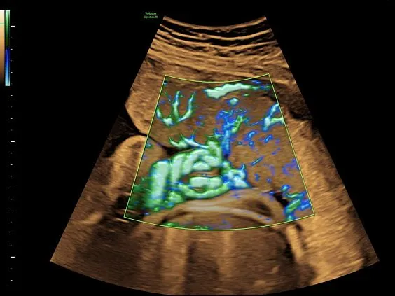 Клинические изображения GE HealthCare Voluson Signature 20 УЗИ аппарат