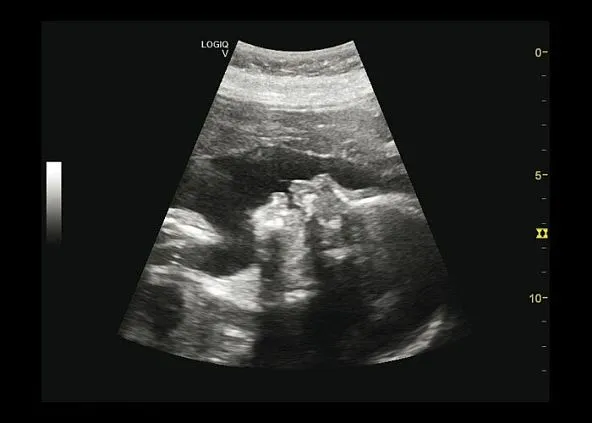 Клинические изображения Ультразвуковая диагностическая система GE Logiq V5