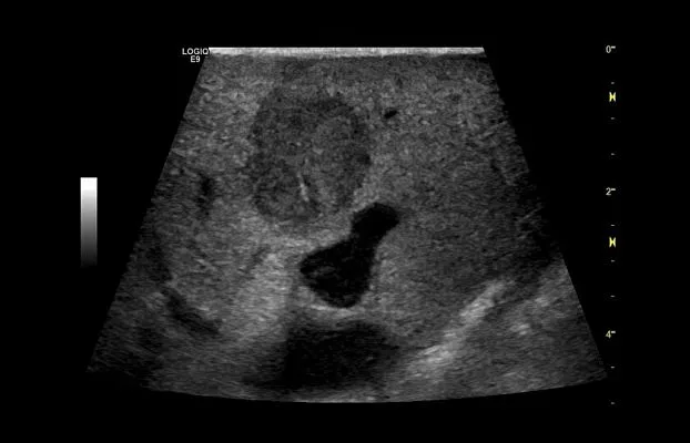 Клинические изображения УЗИ аппарат GE Healthcare Logiq E9 XDclear