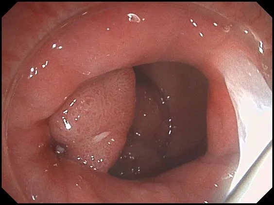 Клинические изображения SonoScape HD-320 видеоэндоскопическая система