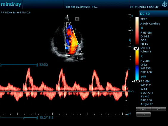Клинические изображения УЗИ аппарат Mindray DC-28