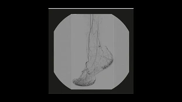 Клинические изображения Рентгенохирургический аппарат типа С-дуга GE OEC Elite CFD